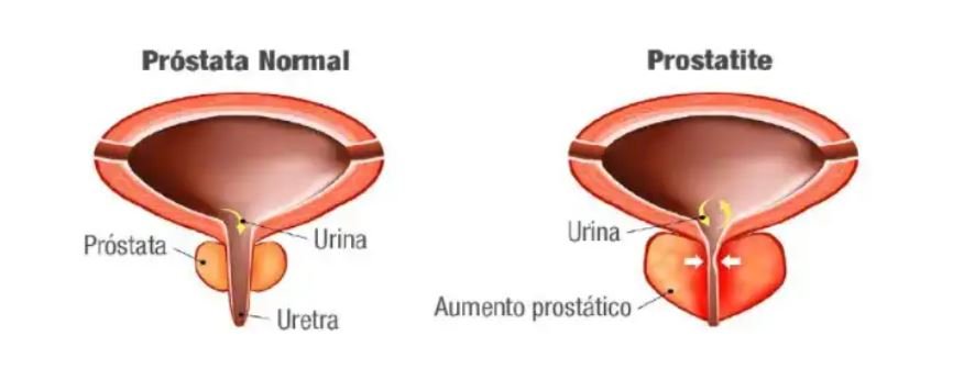 Figura2 prostata